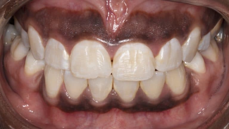 اسباب-اللثة-الداكنة-طرق-العلاج